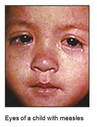 Eyes of child with measles