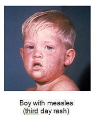 Boy with measles, third day rash