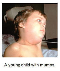 A young child with mumps