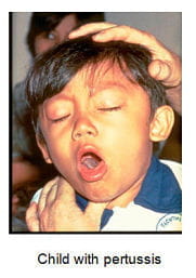 child with pertussis