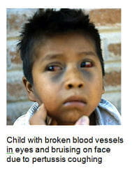 child with broken blood vessels in eyes and bruising on face due to pertussis coughing