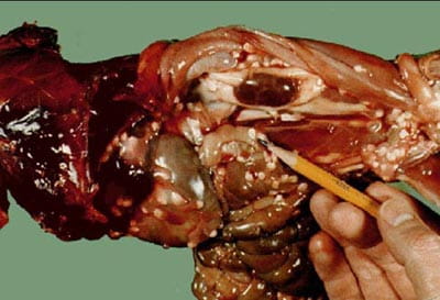 Cysticercosis