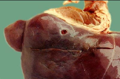 Taenia hydatigena cyst on liver