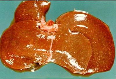 tularemia