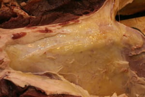 Edema (yellowish fluid) underneath the skin. EHD