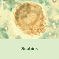 Scabies placeholder image
