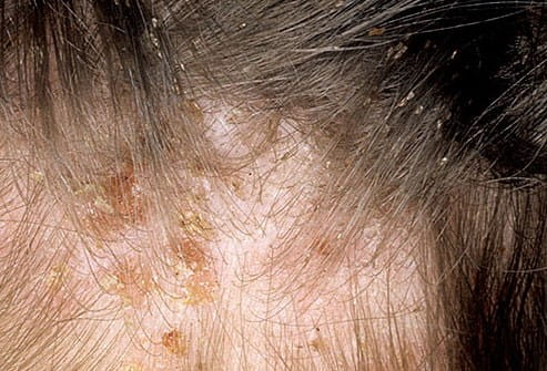 Symptoms of head lice including scabs, scars, and nits.