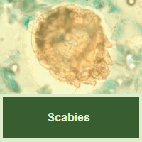 Scabies