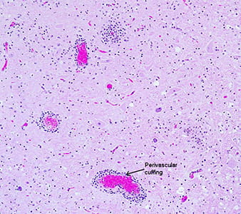 dnr eastern equine encephalitis