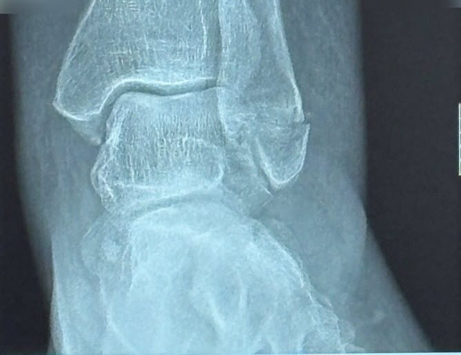 Xray of a broken ankle