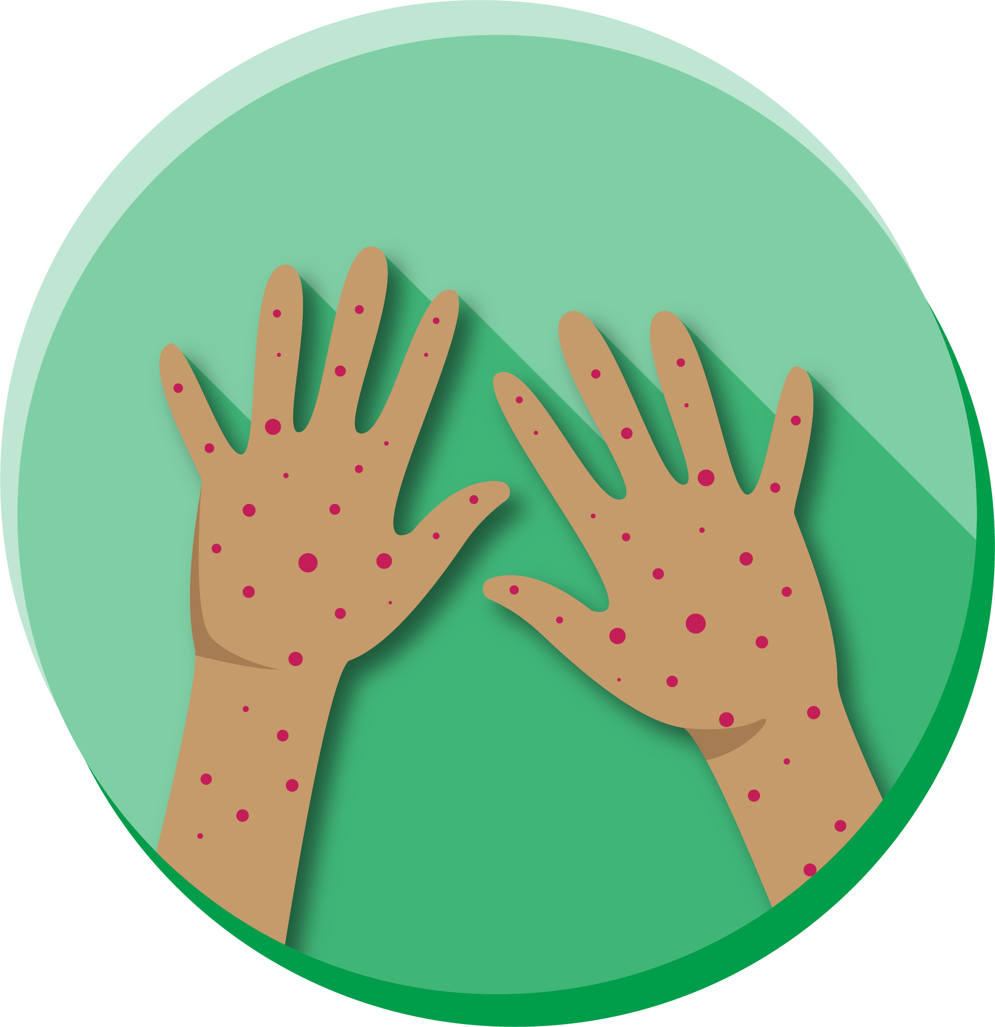Hands with measles rash