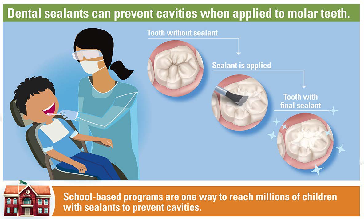 Illustration of a dental professional applying sealant to a child’s molar, comparing a tooth without sealant to one with sealant applied, and showing how sealants help pre-vent cavities. The image also highlights school-based programs that provide preventive dental care.