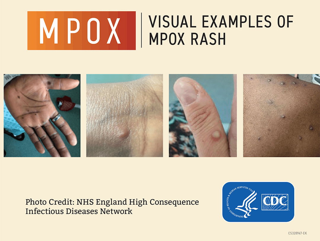 Monkeypox Visuals