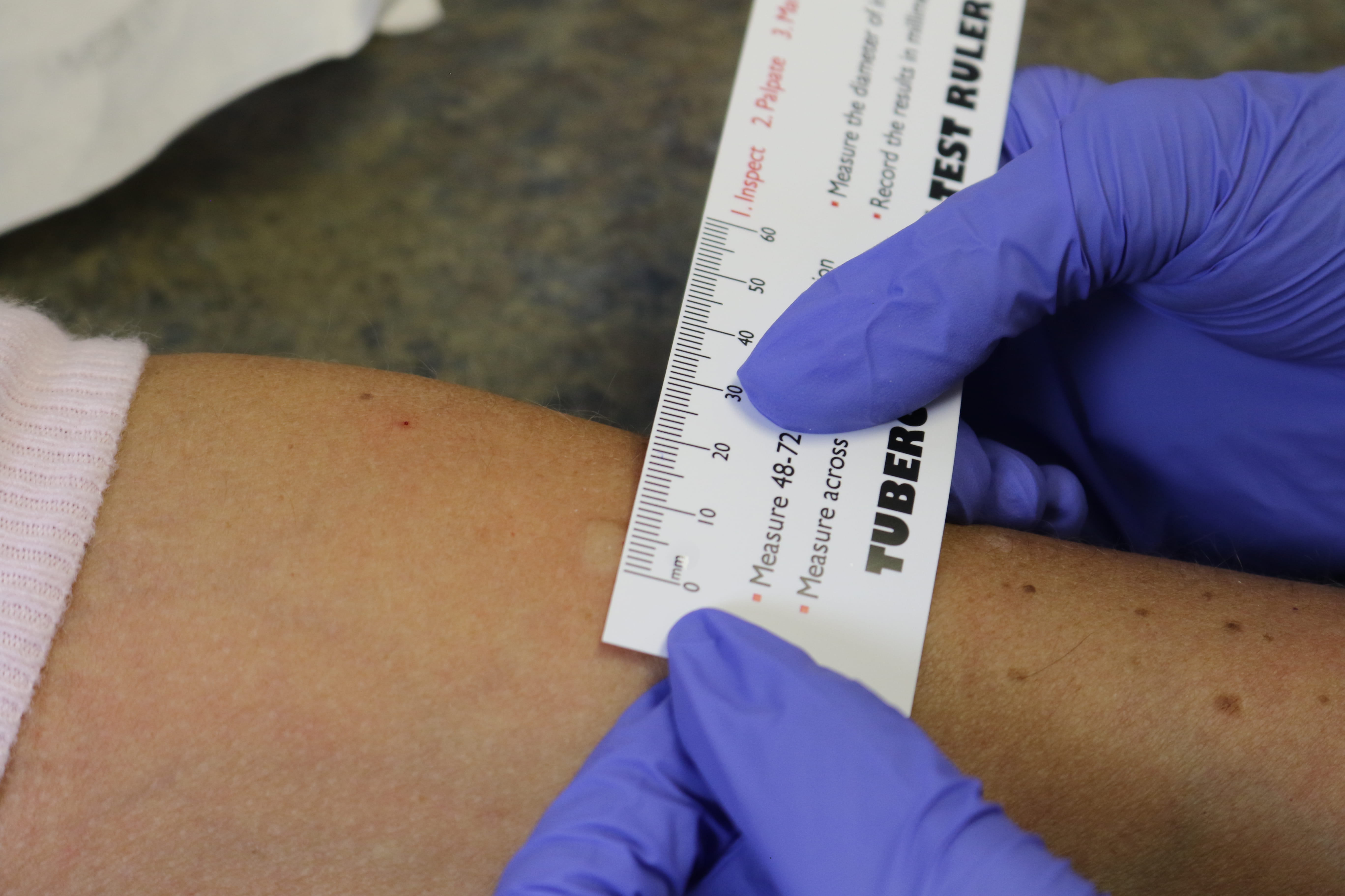 Photo of medical professional measuring a TST result with a ruler